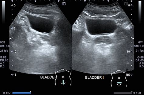 Premium Photo Ultrasound Scan Medical Imaging Of Abdomen Showed Bladder