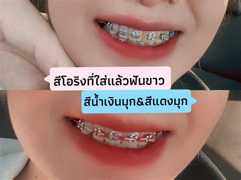 ดัดฟันสีอะไรสวย เลือกสีฟันที่ตระกูลวงการและสายความรู้สึกของคุณ