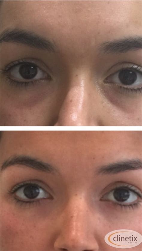 Dermal Fillers For Dark Circles Under The Eye Clinetix Rejuvenation