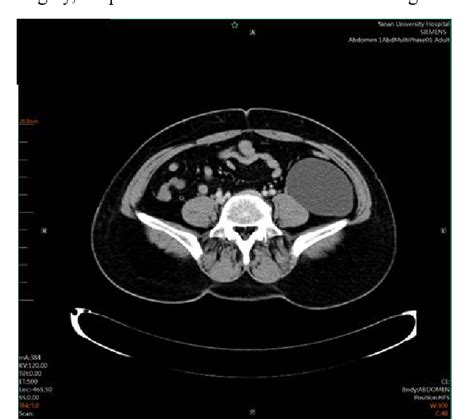 Figure 1 from Case report of a retroperitoneal cyst | Semantic Scholar