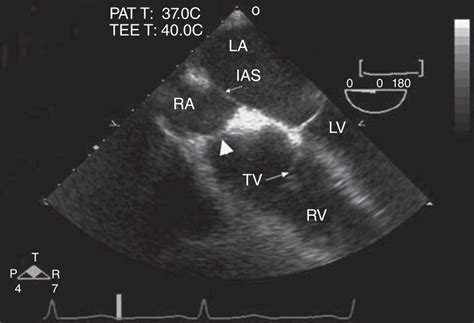 Cor Triatriatum Pulmonary Vein Stenosis And Atresia Of The Common