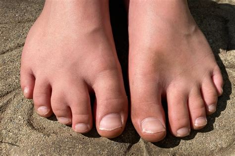 Pfeiffer Syndrome Hands And Feet