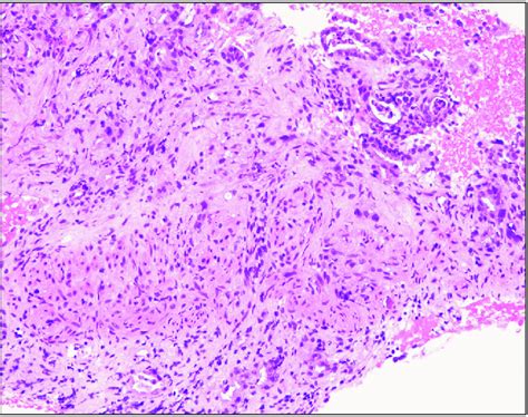 Histology Of Pancreatic Adenocarcinoma Acquired From Endoscopic