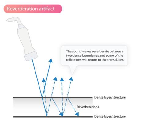 ultrasound-reverberation-artifact-artifacts-echocardiography – The ...