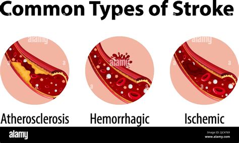 Infographic Of Common Types Of Stroke Illustration Stock Vector Image