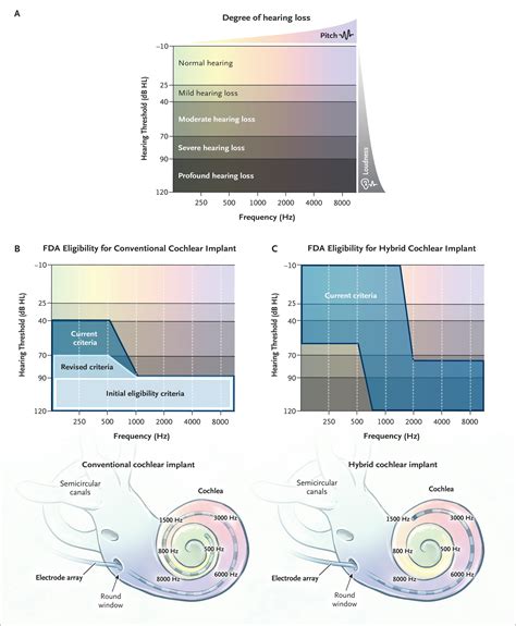 Cochlear Implantation In Adults NEJM