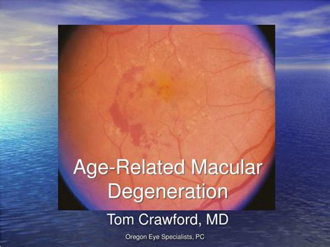 Ppt Age Related Macular Degeneration Powerpoint Presentation Free