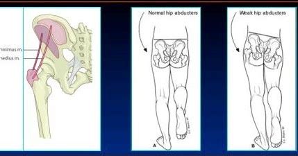 waddling gait / myopathic gait / gait training / myopathic gait treatment / waddling gait ...