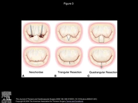 Mitral Valve Hemodynamics After Repair Of Acute Posterior Leaflet