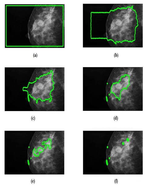 Level Set Based Active Contour Segmentation A Iteration B