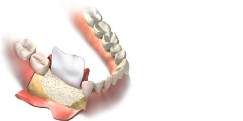 Guided Tissue Bone Regeneration - Miami, FL - Periodontists