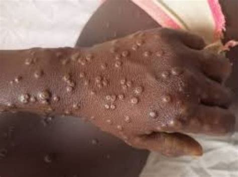 Variole du singe Mpox dans la sous région le Bénin davantage menacé