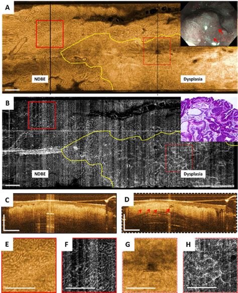 Oct Octa And Endoscopy Images Acquired Prior To Emr A Shows En