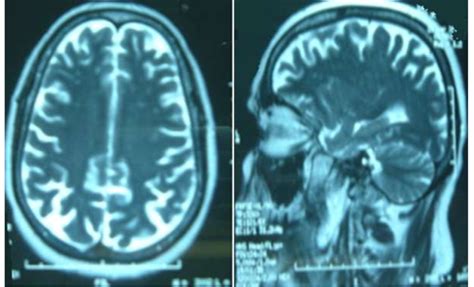 MRI findings of cerebral vasculitis including multiple supratentorial ...