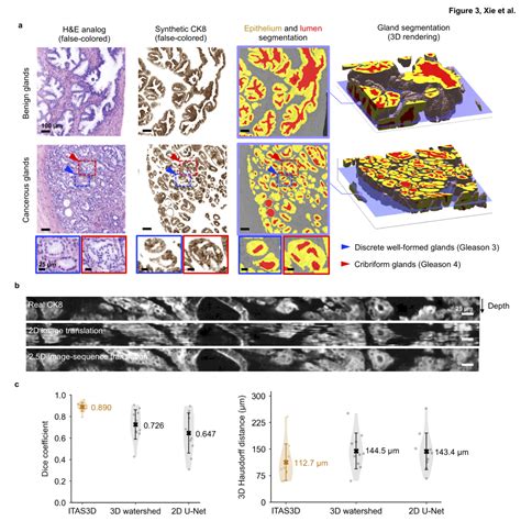 Pca Bx Dpathology The Cancer Imaging Archive Tcia