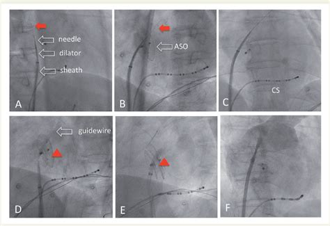 Figure From Transseptal Puncture And Catheter Ablation Of Atrial