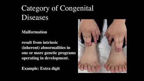 Congenital Limb Deformity Youtube