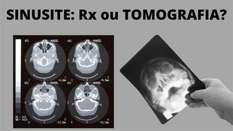 Raio X Ou Tomografia Para Sinusite Quem Tem Sinusite Precisa Fazer Rx