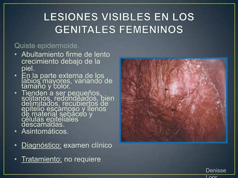 Lesiones visibles en los genitales femeninos | PPTX