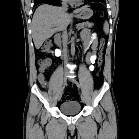 Appendiceal Mucocele Image Radiopaedia Org