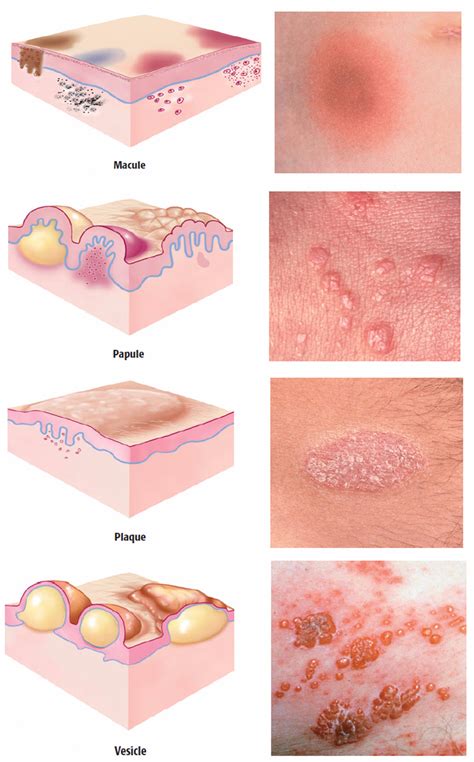 Skin Lesions Types