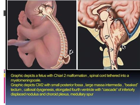 Imaging Of The Craniovertebral Junction