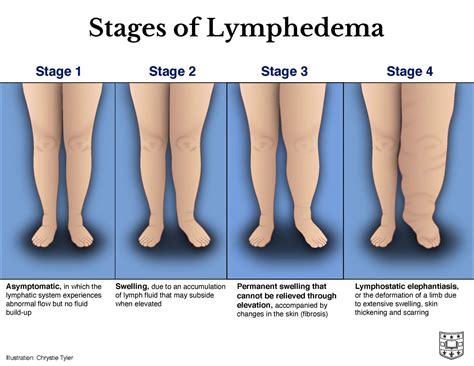 Ask the Doctors: Lymphedema Symptoms and Causes with Doctors Sacks and ...