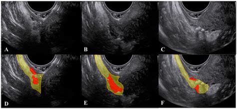 Jcm Free Full Text Ultrasound Of The Uterosacral Ligament