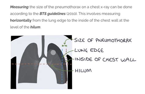 Pneumothorax Flashcards Quizlet