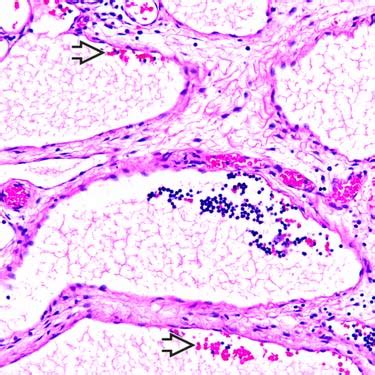 Lymphangioma Histology