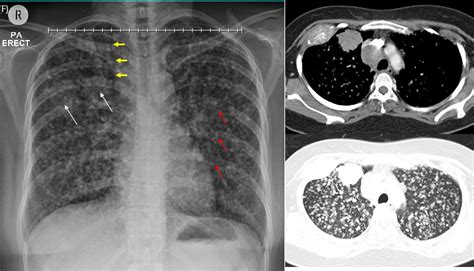 Lung adenocarcinoma – Radiology Cases