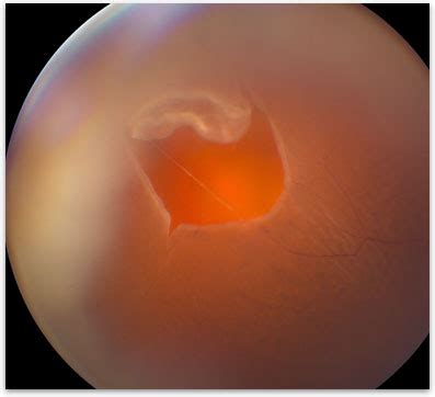 Lattice Degeneration With Retinal Holes - A Pictures Of Hole 2018