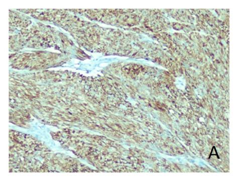 A Immunohistochemical Staining For Desmin Shows Strong Diffuse