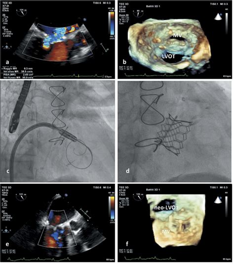 Valve in ring procedure. (a-b) Pre-procedure echocardiography (TEE ...