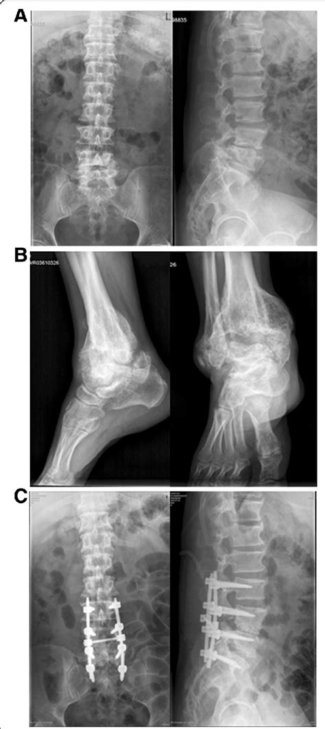 A X Ray Of The Lumbar Spine Revealed Narrowing Of Intervertebral Space