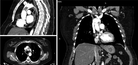 Contrast Enhanced Computed Tomography With Multiplanar Reconstruction Download Scientific