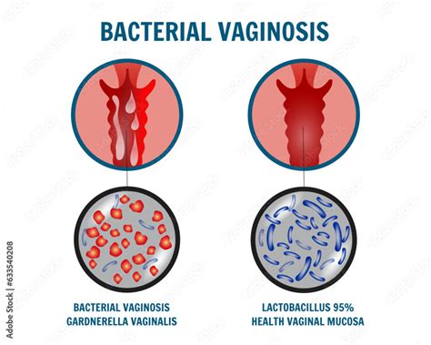 Gynecology Disease Bacterial Vaginosis Medical Infographic Stock Vector Adobe Stock