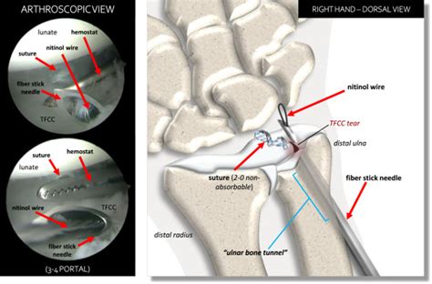 Arthroscopic Tfcc Ulnar Bone Tunnel Foveal Repair In Adult Patients Arthroscopy Techniques