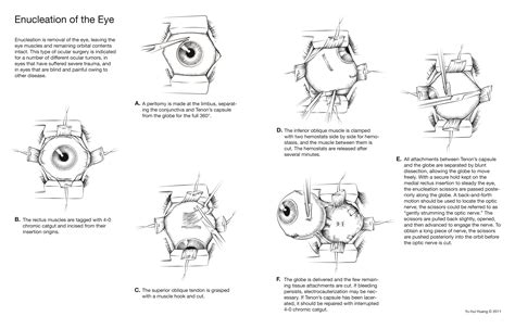 Enucleation Of Eye