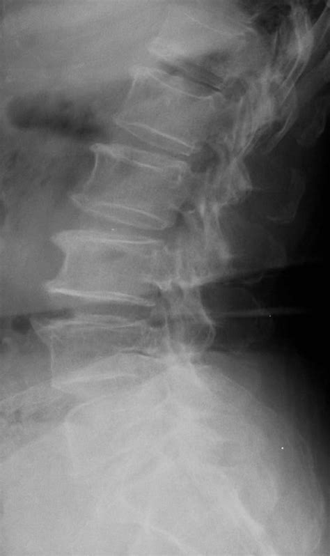 Osteophytosis And Dsn Demonstrated On A Lateral Lumbar Spine X Ray