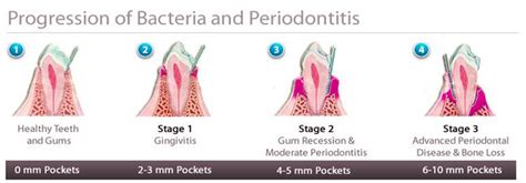 Diagram Of Progression Of Gum Disease Image Graph Diagram