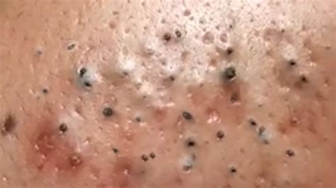 Dr Sandra Lee Acne Treatment And Removal Blackheads 269 Blackheads