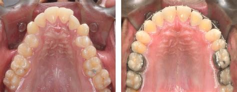 Rapid Correction Of Constricted Maxillary Arch In A Class Iii Patient