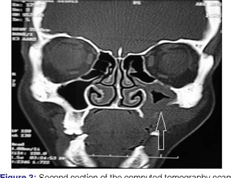 Figure 3 From Osteolytic Nasal Polyp Of The Maxillary Sinus Mimicking