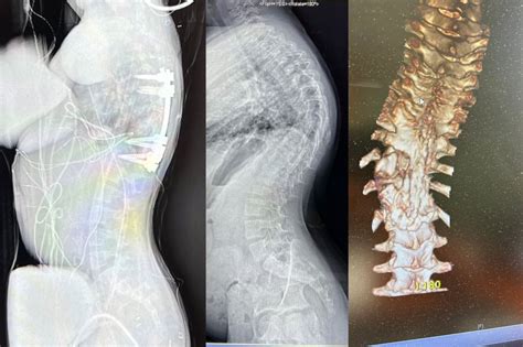 Kyphosis KyphoScoliosis Treatment CLEAR Scoliosis Schroth, 58% OFF