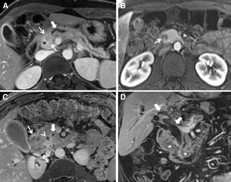 Neoplastic Mimics Of Pancreas Adenocarcinoma Axial T Weighted