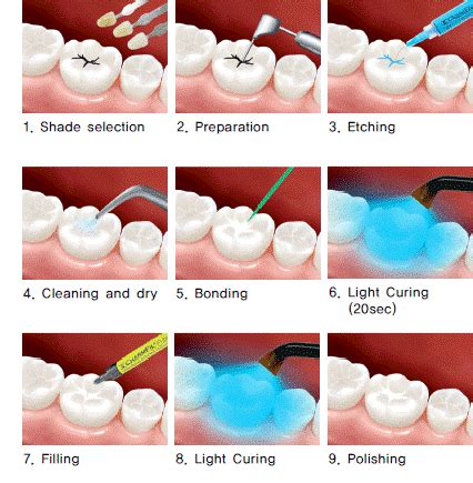 Dental Sealants Diagram