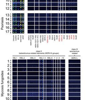 Transcriptional Activity Of HERV W Proviral Loci In Lesion And