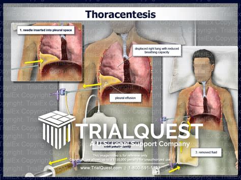 Thoracentesis - TrialExhibits Inc.