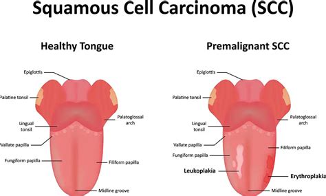 Tonsil Cancer Vs Tonsil Stones CancerWalls